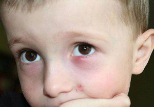 Чем и как лечить ячмень на глазу у ребенка: лекарственные препараты и народная медицина, запрещённые действия