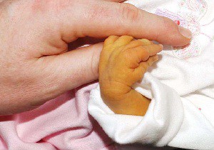Характерное изменение оттенка кожи — желтуха у новорожденных: причины и последствия, классификация и лечение заболевания