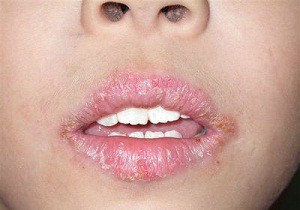 Хейлит или заеды в уголках рта у детей: причины и лечение при помощи специальной диеты, медикаментов и народных средств
