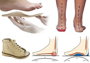 Как выбрать ортопедическую обувь для детей при вальгусной деформации стопы: полезные советы