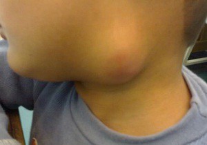 Лимфаденит или воспаление лимфоузлов на шее: лечение в домашних условиях у детей при помощи эффективных методов