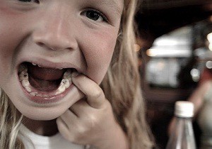 Основные причины возникновения кариеса молочных зубов у детей раннего возраста: лечение и профилактика заболевания