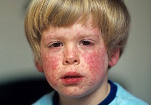 Острое инфекционное заболевание — краснуха у детей: симптомы и лечение, профилактика, фото проявлений недуга