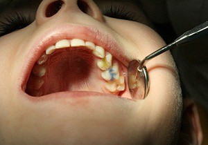 Причины развития пульпита молочных зубов у детей и лечение эффективными и безболезненными способами