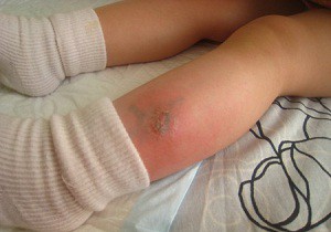 Признаки и симптомы аллергии на укусы комаров у детей: лечение и правила оказания помощи при отеке Квинке