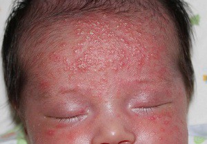 Вероятные причины появления прыщиков на лице у новорожденного и способы лечения неприятного явления