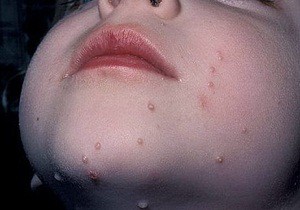Вирусное заболевание кожи — контагиозный моллюск у детей: фото папул, пути передачи и заражения, способы лечения заболевания