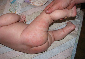 Воспаление кожных покровов или опрелости у новорожденных: чем лечить разные степени раздражения