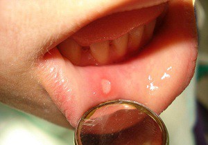 Воспалительный процесс на слизистых оболочках полости рта — стоматит у детей: симптомы и лечение, фото заболевания и меры профилактики