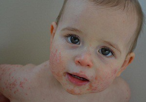 Заболевание аллергического характера — атопический дерматит у детей: симптомы и лечение, фото проявления недуга и меры профилактики