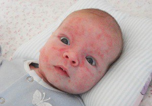 аллергия у новорожденных фото