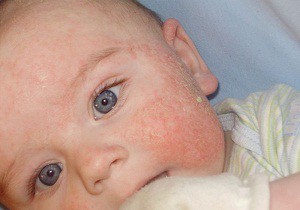как выглядит аллергия у новорожденного фото
