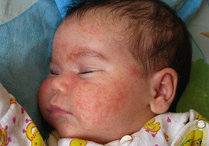 аллергия у новорожденного чем лечить