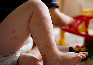 от укусов комаров для детей