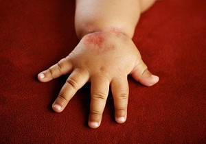 аллергия на клубнику у ребенка лечение