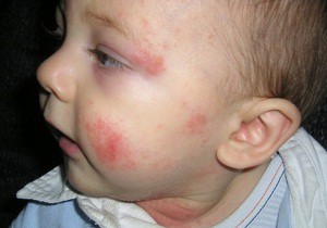 аллергический дерматит фото у детей