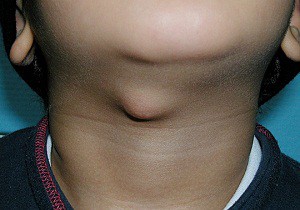 воспаление лимфоузлов на шее у ребенка лечение