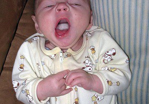 молочница у новорожденных во рту фото