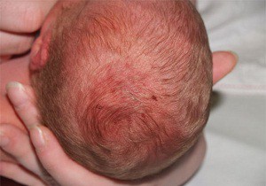 гематома на голове у новорожденного после родов