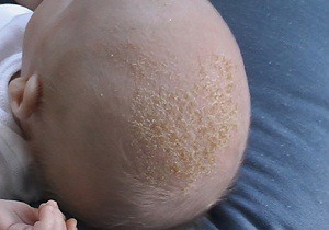 почему у новорожденных шелушится кожа