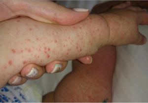 энтеровирусная инфекция у детей комаровский