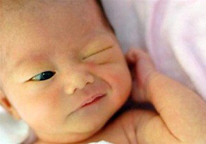 дакриоцистит новорожденных фото