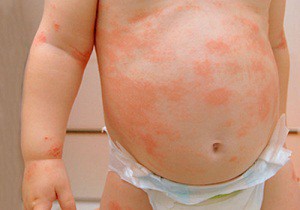 атопический дерматит у детей лечение народными средствами