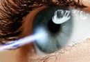 Лазерная коррекция зрения — особенности и преимущества