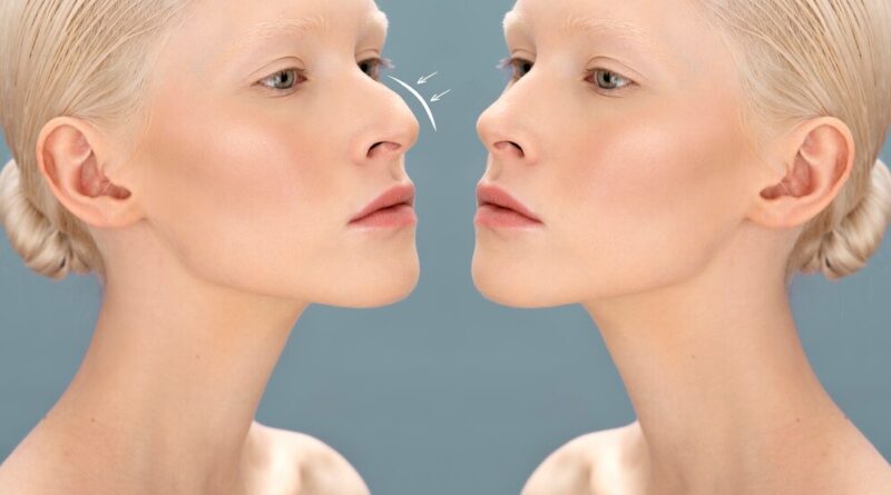 Ринопластика: операция, методы и восстановление