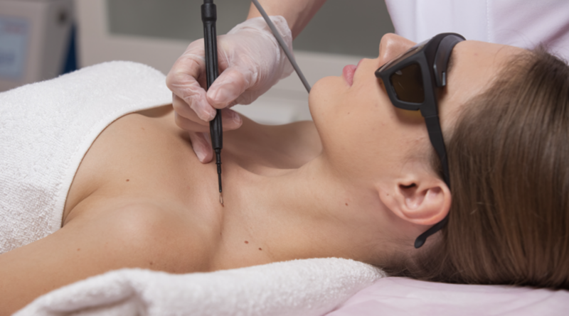 Лазерное удаление новообразований: безопасный путь к здоровой коже